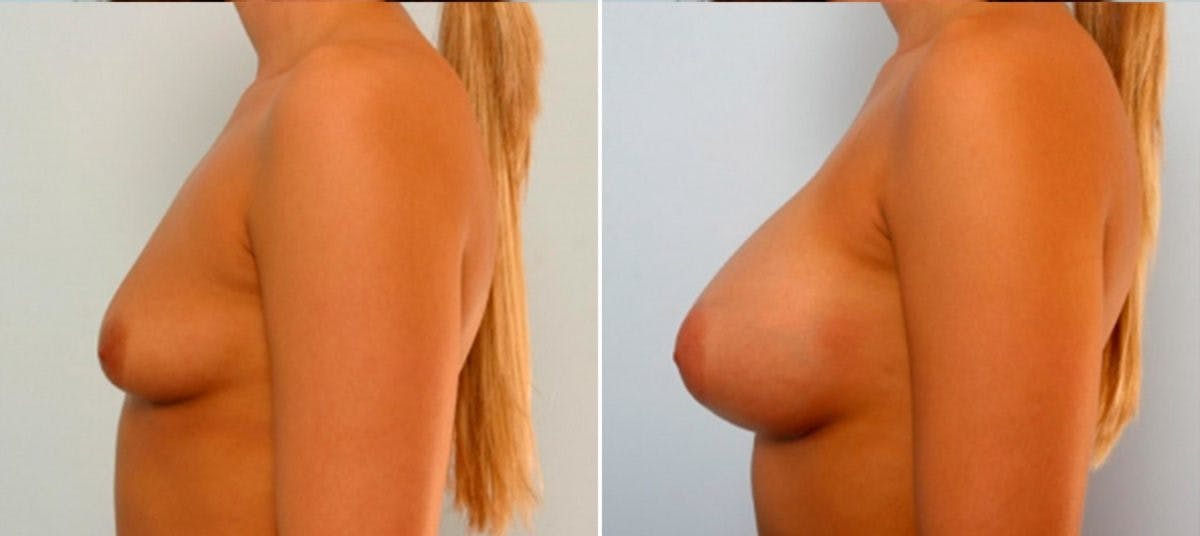Breast Augmentation Before & After Gallery - Patient 54884034 - Image 5