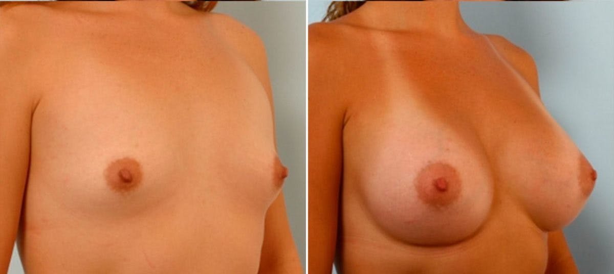 Breast Augmentation Before & After Gallery - Patient 54884037 - Image 2