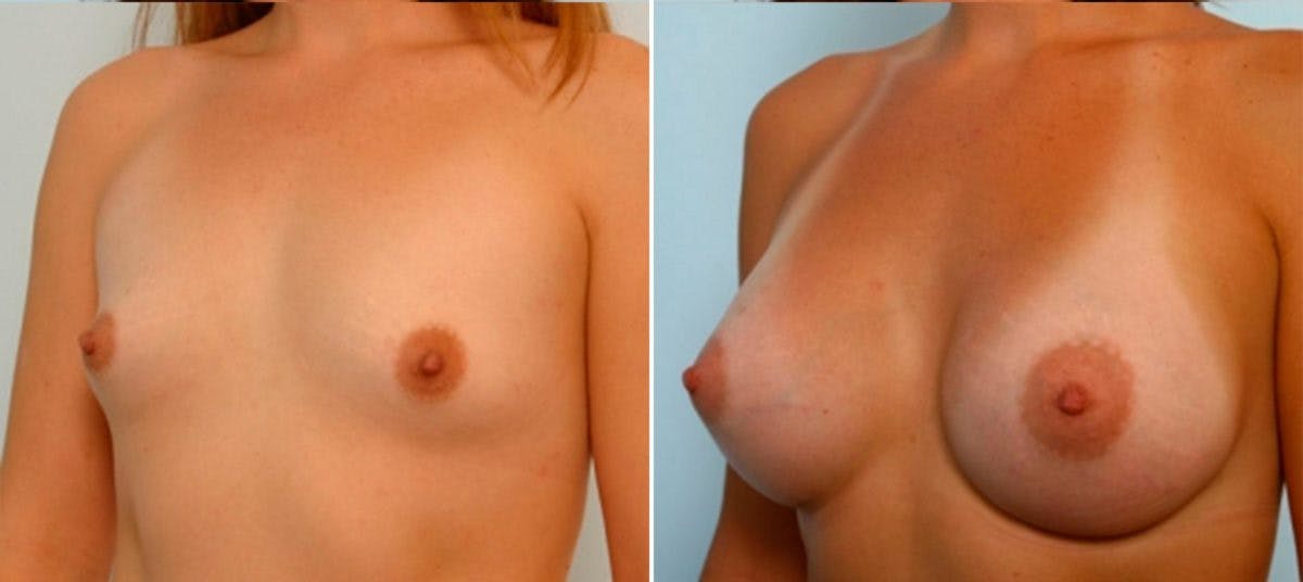 Breast Augmentation Before & After Gallery - Patient 54884037 - Image 4