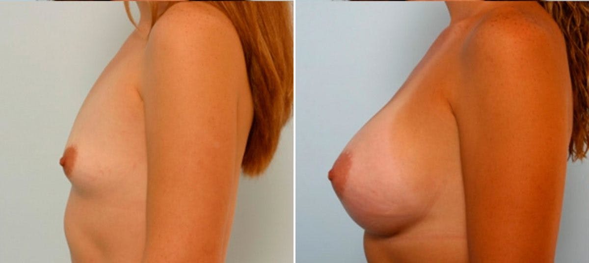 Breast Augmentation Before & After Gallery - Patient 54884037 - Image 5