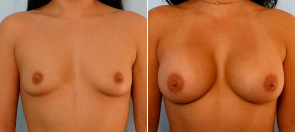 Breast Augmentation Before & After Gallery - Patient 54884044 - Image 1