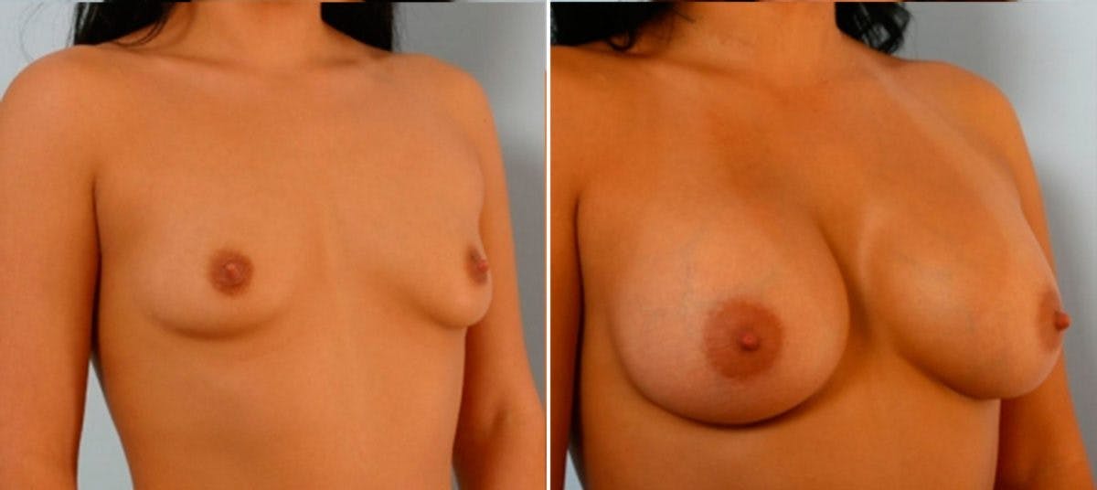 Breast Augmentation Before & After Gallery - Patient 54884044 - Image 2