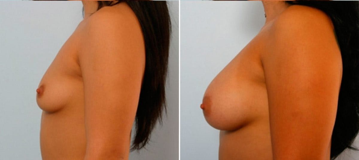 Breast Augmentation Before & After Gallery - Patient 54884044 - Image 5