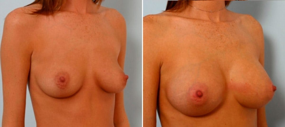 Breast Augmentation Before & After Gallery - Patient 54884047 - Image 2
