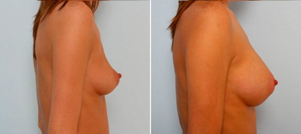 Breast Augmentation Before & After Gallery - Patient 54884047 - Image 3
