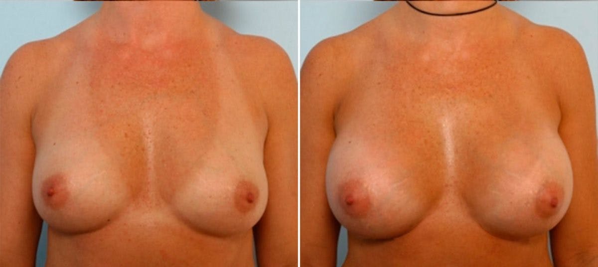 Breast Augmentation Before & After Gallery - Patient 54884048 - Image 1