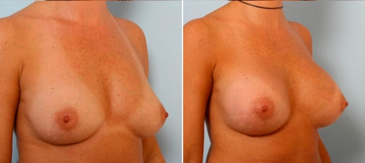 Breast Augmentation Before & After Gallery - Patient 54884048 - Image 2