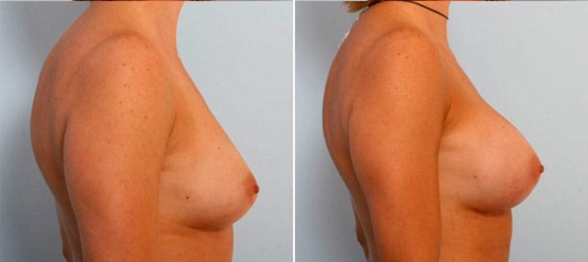 Breast Augmentation Before & After Gallery - Patient 54884048 - Image 3