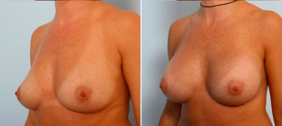 Breast Augmentation Before & After Gallery - Patient 54884048 - Image 4