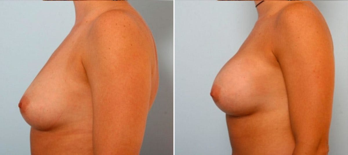 Breast Augmentation Before & After Gallery - Patient 54884048 - Image 5