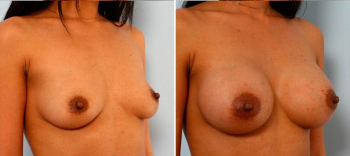 Breast Augmentation Before & After Gallery - Patient 54884049 - Image 2