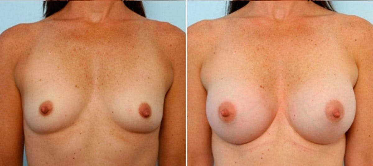 Breast Augmentation Before & After Gallery - Patient 54884050 - Image 1