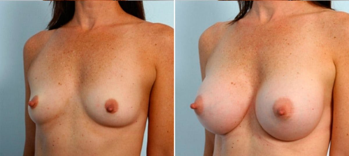Breast Augmentation Before & After Gallery - Patient 54884050 - Image 4