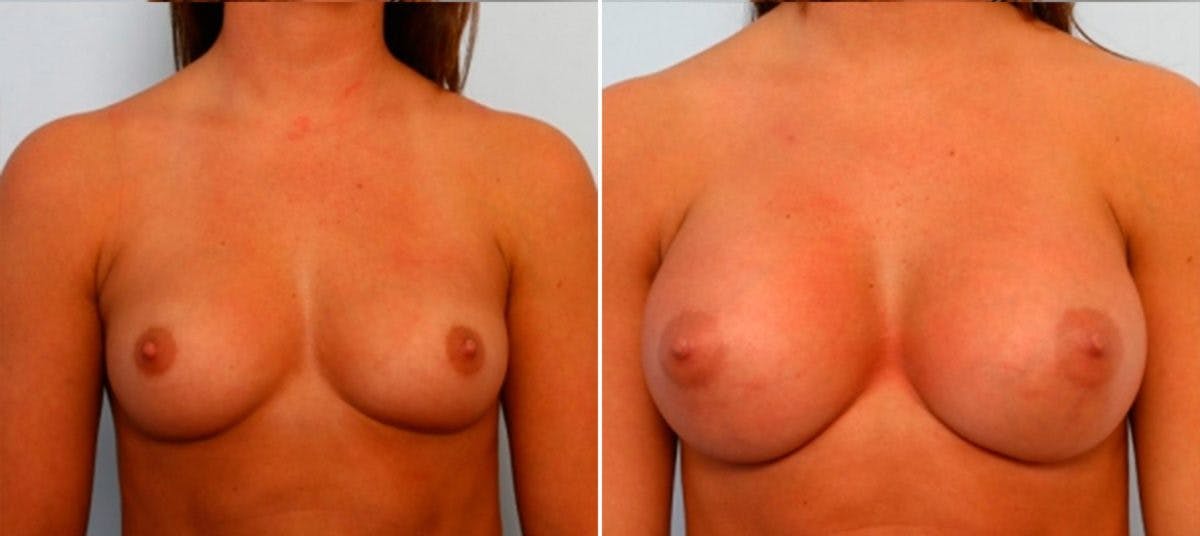 Breast Augmentation Before & After Gallery - Patient 54884051 - Image 1
