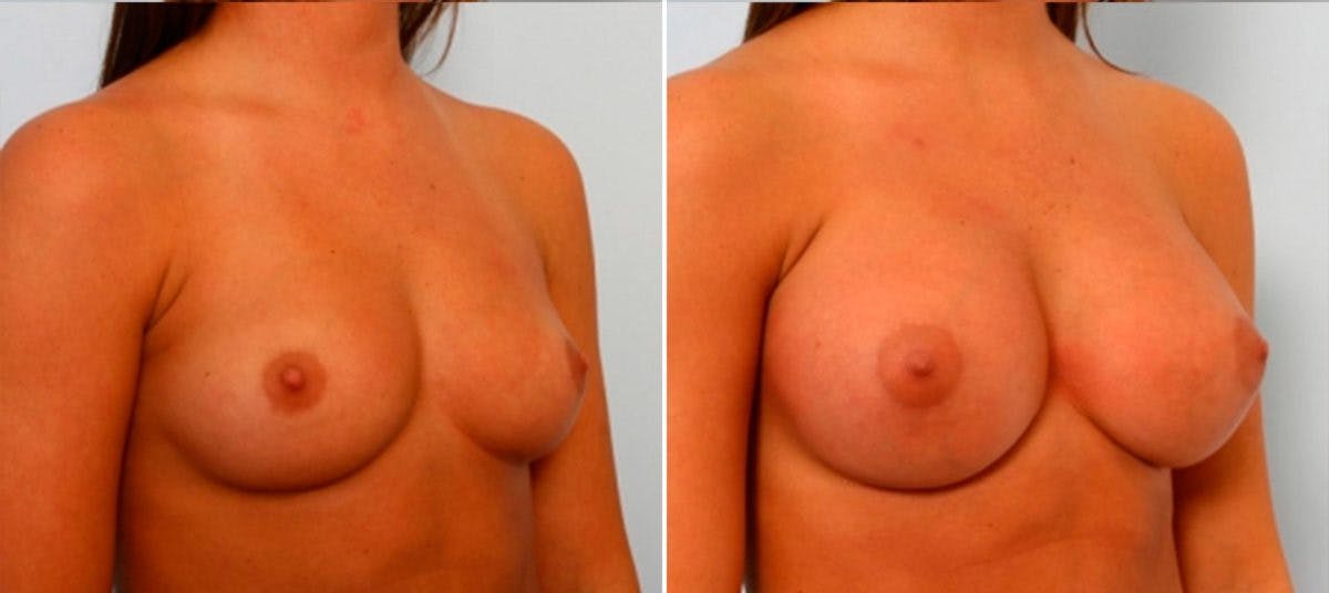 Breast Augmentation Before & After Gallery - Patient 54884051 - Image 2