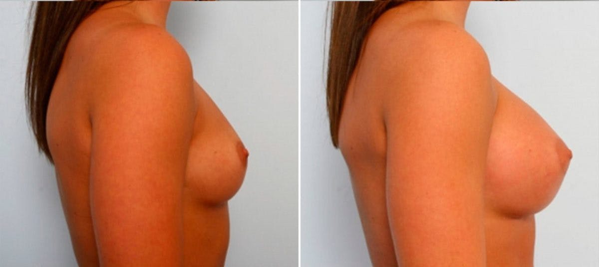 Breast Augmentation Before & After Gallery - Patient 54884051 - Image 3