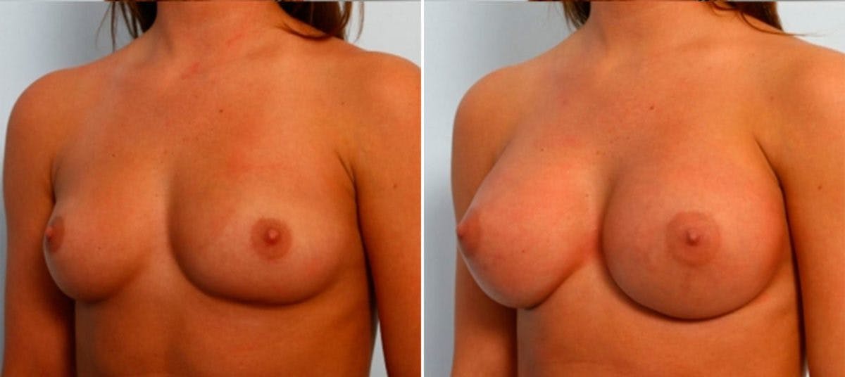 Breast Augmentation Before & After Gallery - Patient 54884051 - Image 4
