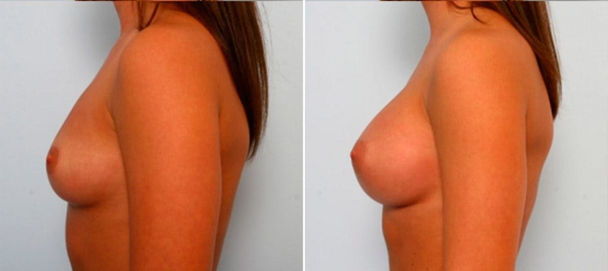 Breast Augmentation Before & After Gallery - Patient 54884051 - Image 5