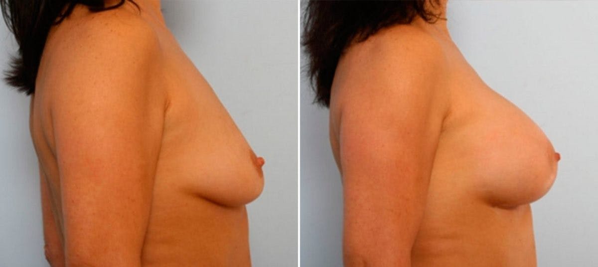 Breast Augmentation Before & After Gallery - Patient 54884052 - Image 3