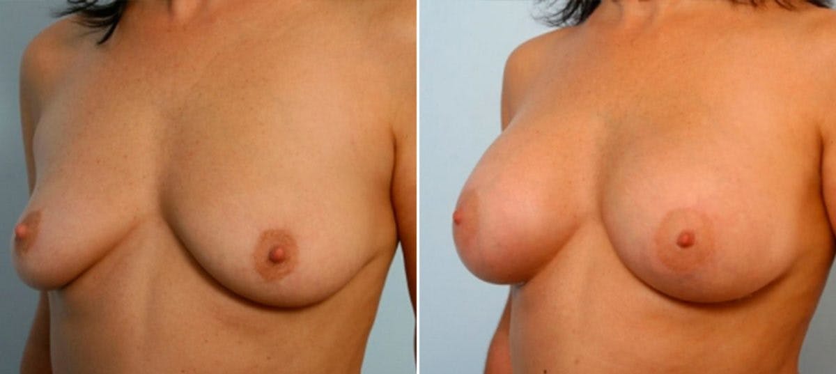Breast Augmentation Before & After Gallery - Patient 54884052 - Image 4