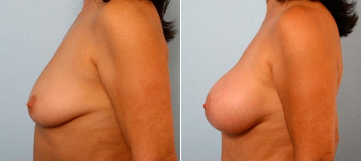 Breast Augmentation Before & After Gallery - Patient 54884052 - Image 5