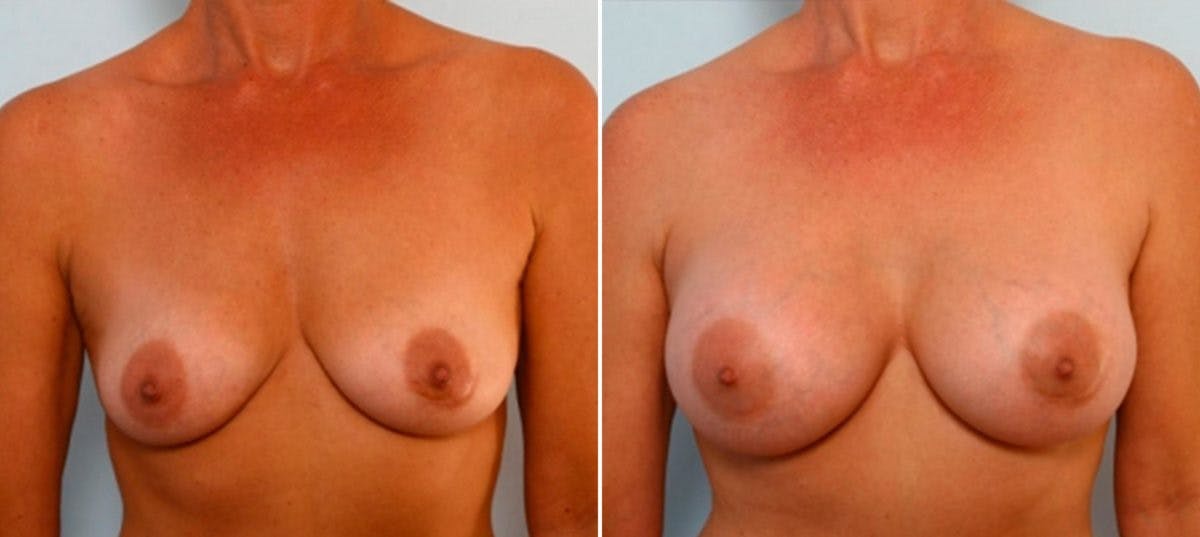 Breast Augmentation Before & After Gallery - Patient 54884053 - Image 1