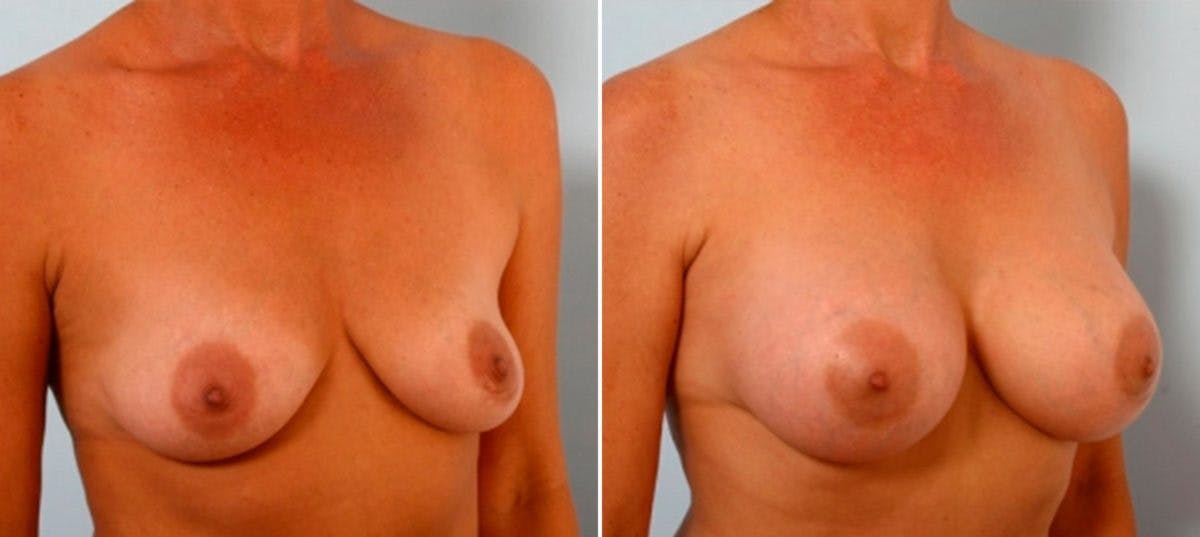 Breast Augmentation Before & After Gallery - Patient 54884053 - Image 2