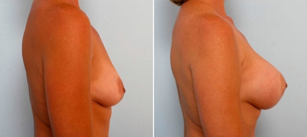 Breast Augmentation Before & After Gallery - Patient 54884053 - Image 3