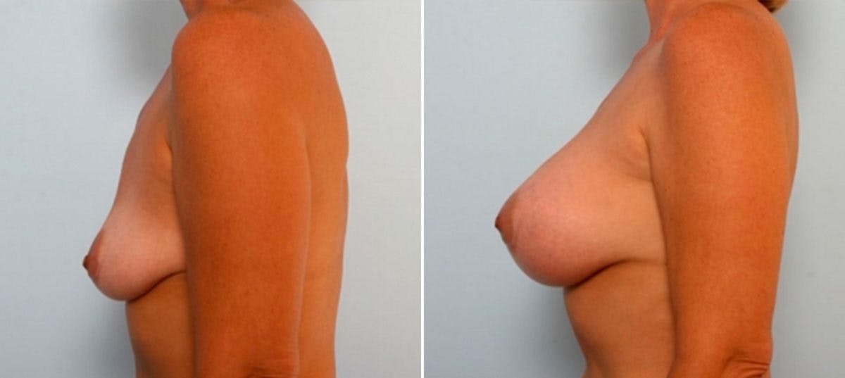 Breast Augmentation Before & After Gallery - Patient 54884053 - Image 5