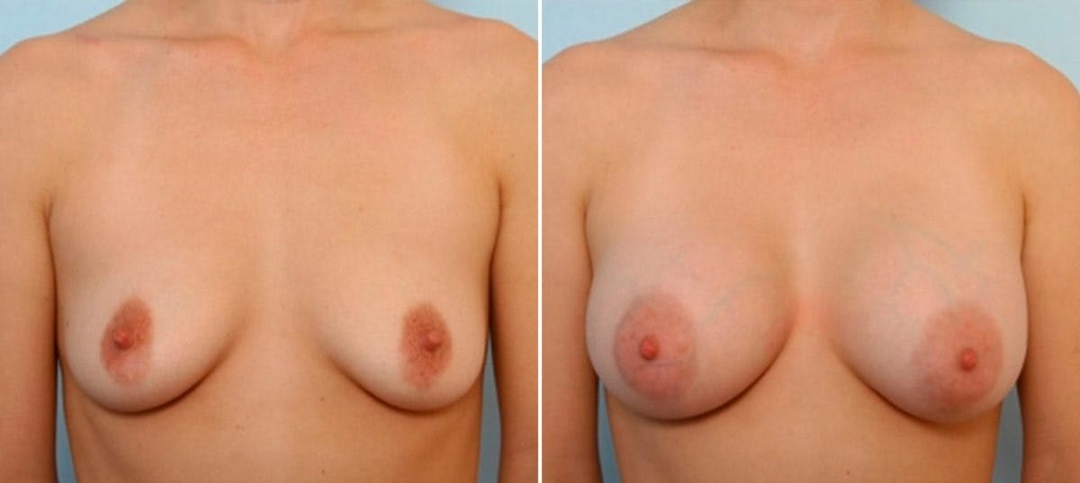 Breast Augmentation Before & After Gallery - Patient 54884054 - Image 1