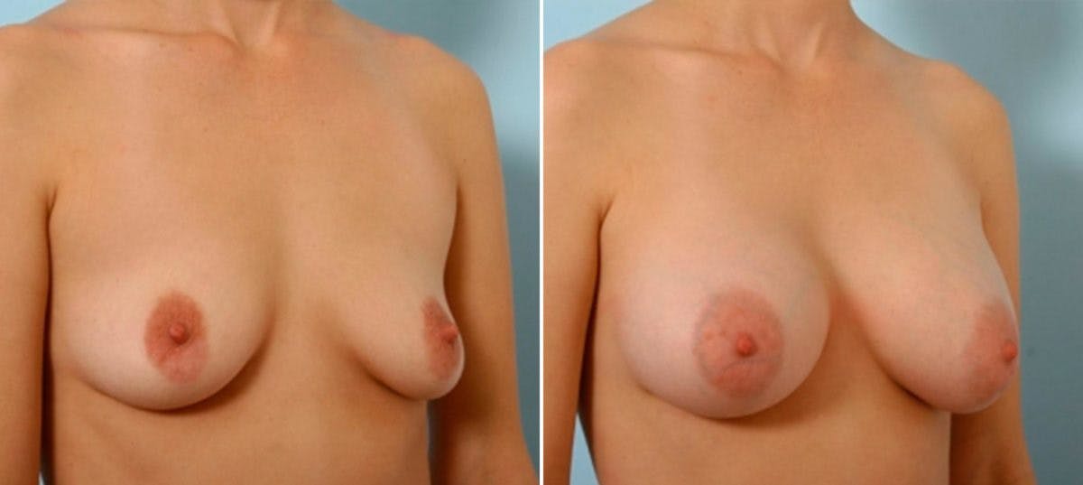 Breast Augmentation Before & After Gallery - Patient 54884054 - Image 2