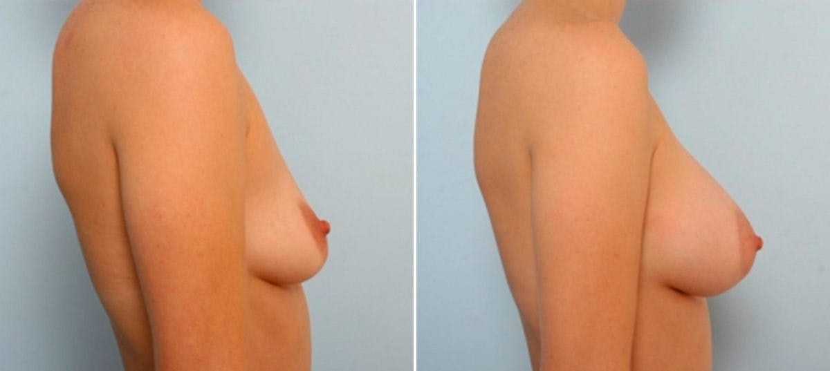 Breast Augmentation Before & After Gallery - Patient 54884054 - Image 3