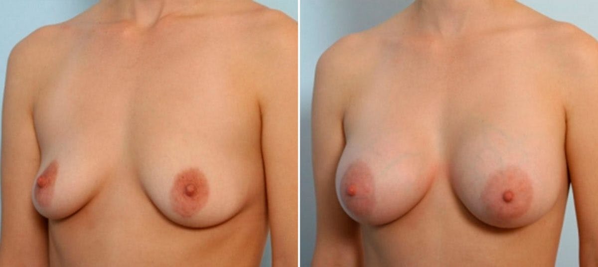Breast Augmentation Before & After Gallery - Patient 54884054 - Image 4