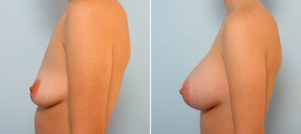 Breast Augmentation Before & After Gallery - Patient 54884054 - Image 5