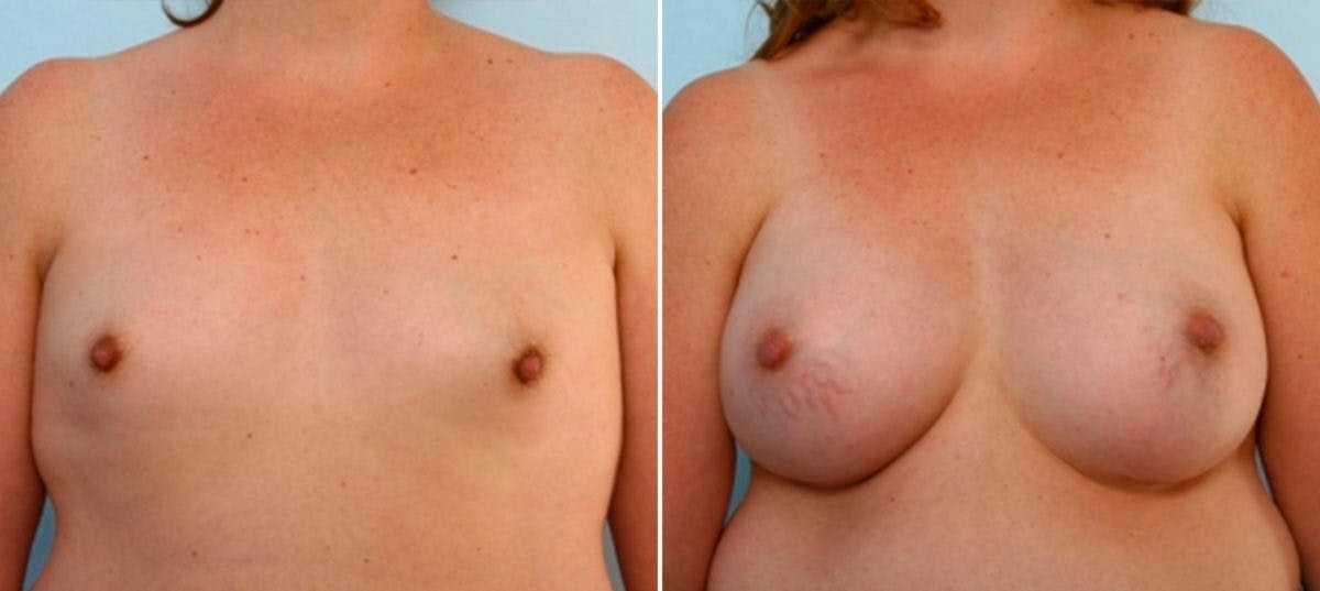 Breast Augmentation Before & After Photo - Patient 54884055 - Image 1