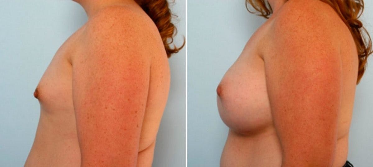 Breast Augmentation Before & After Gallery - Patient 54884055 - Image 5