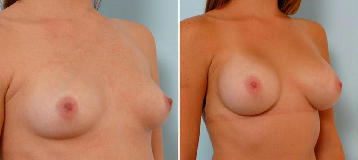 Breast Augmentation Before & After Gallery - Patient 54885974 - Image 2