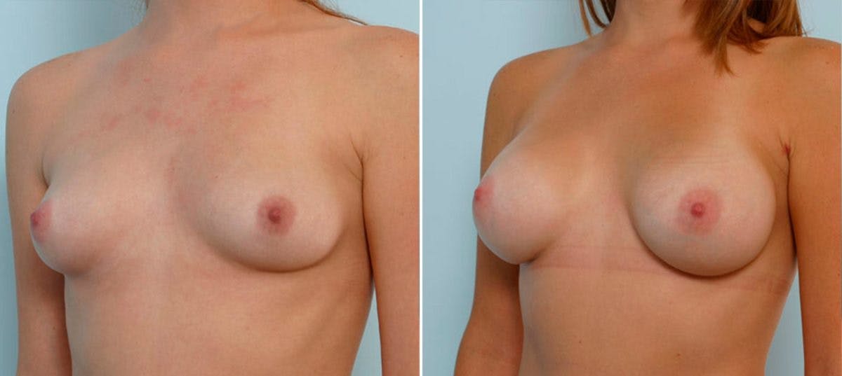 Breast Augmentation Before & After Gallery - Patient 54885974 - Image 4