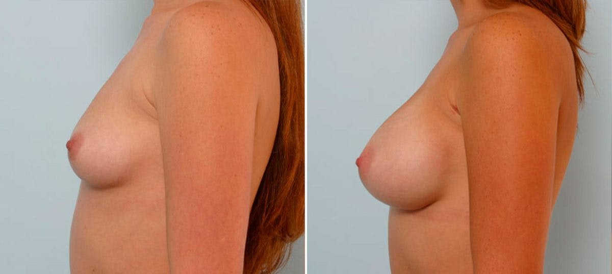 Breast Augmentation Before & After Gallery - Patient 54885974 - Image 5