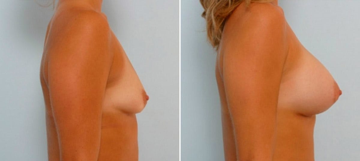 Breast Augmentation Before & After Gallery - Patient 54885975 - Image 3