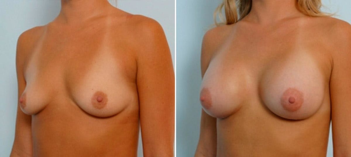 Breast Augmentation Before & After Gallery - Patient 54885975 - Image 4