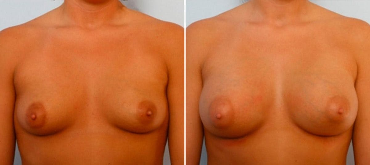 Breast Augmentation Before & After Gallery - Patient 54885976 - Image 1