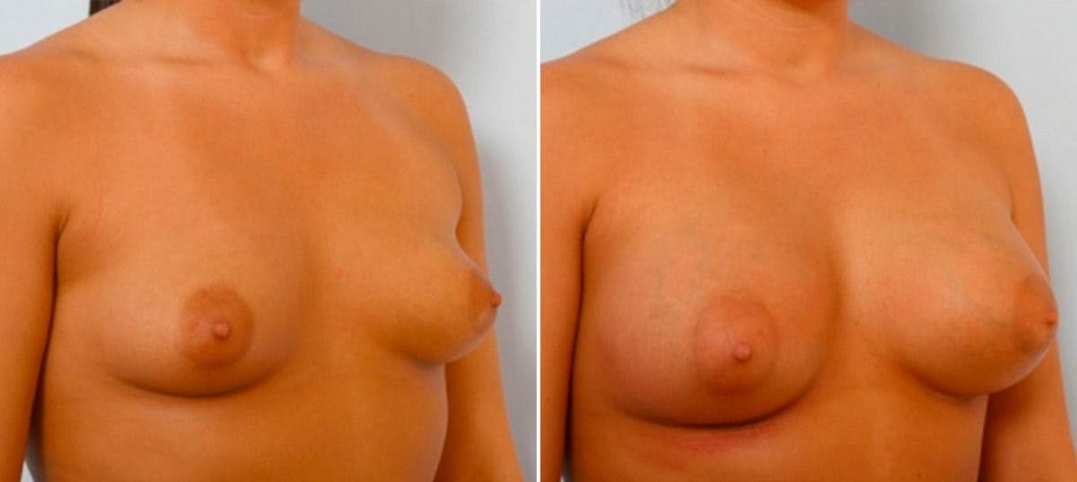 Breast Augmentation Before & After Gallery - Patient 54885976 - Image 2