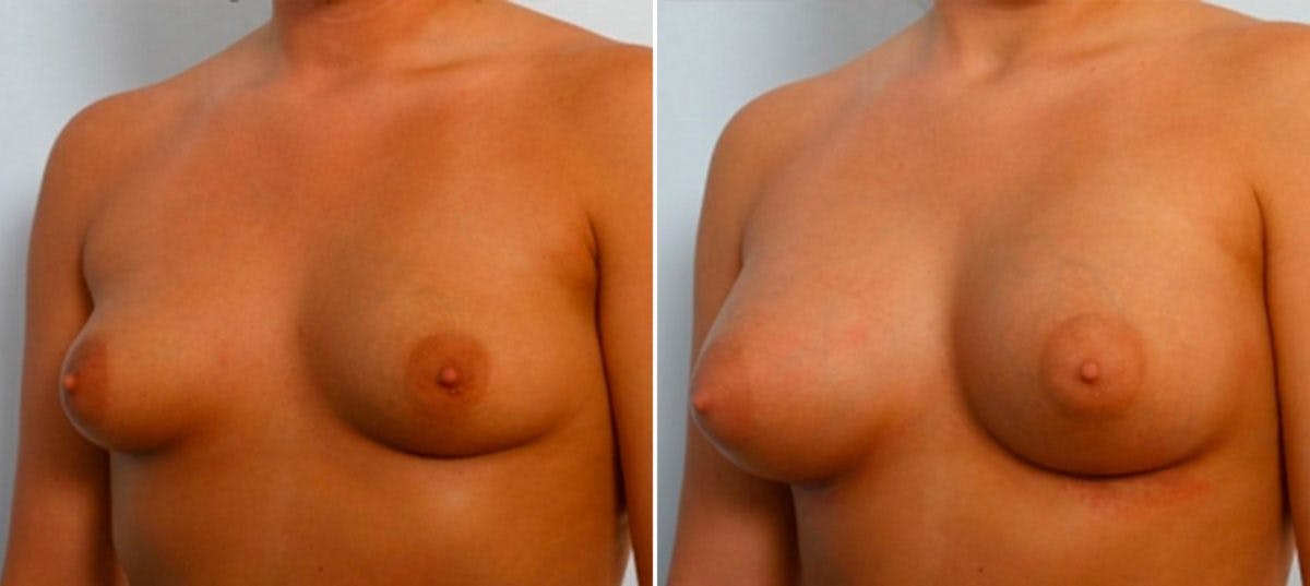 Breast Augmentation Before & After Gallery - Patient 54885976 - Image 4