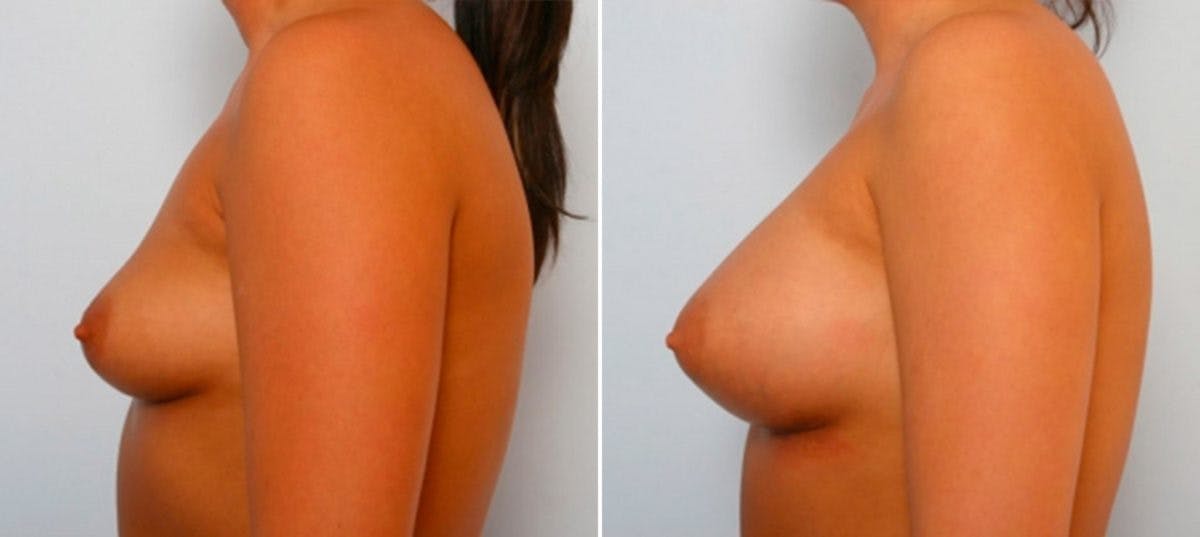 Breast Augmentation Before & After Gallery - Patient 54885976 - Image 5