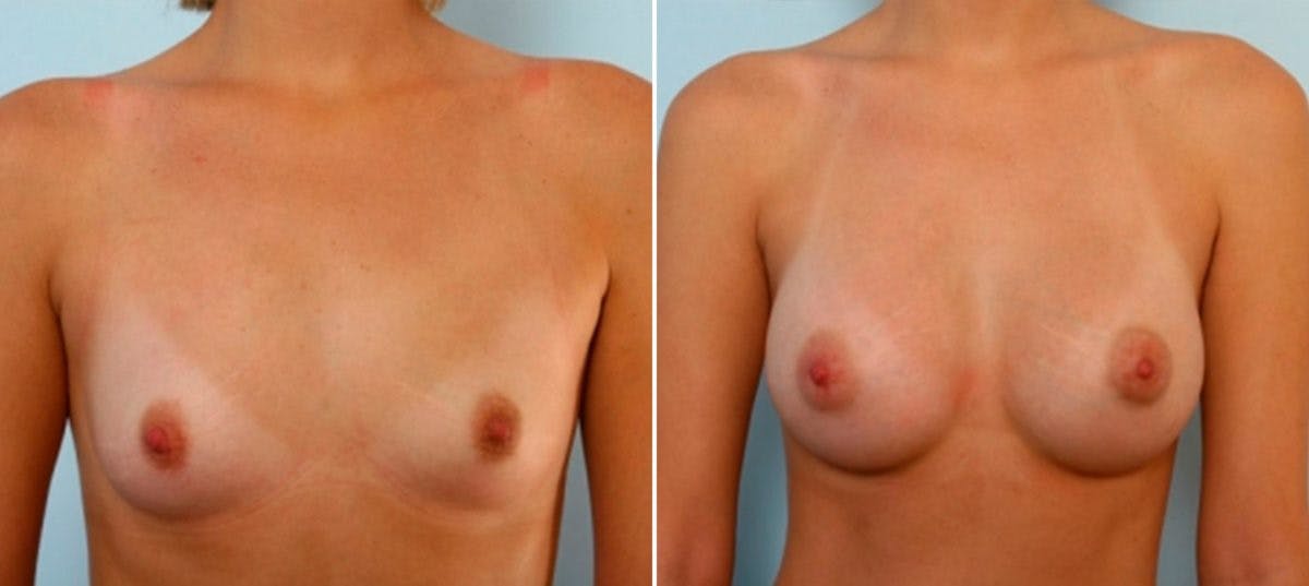Breast Augmentation Before & After Gallery - Patient 54885977 - Image 1