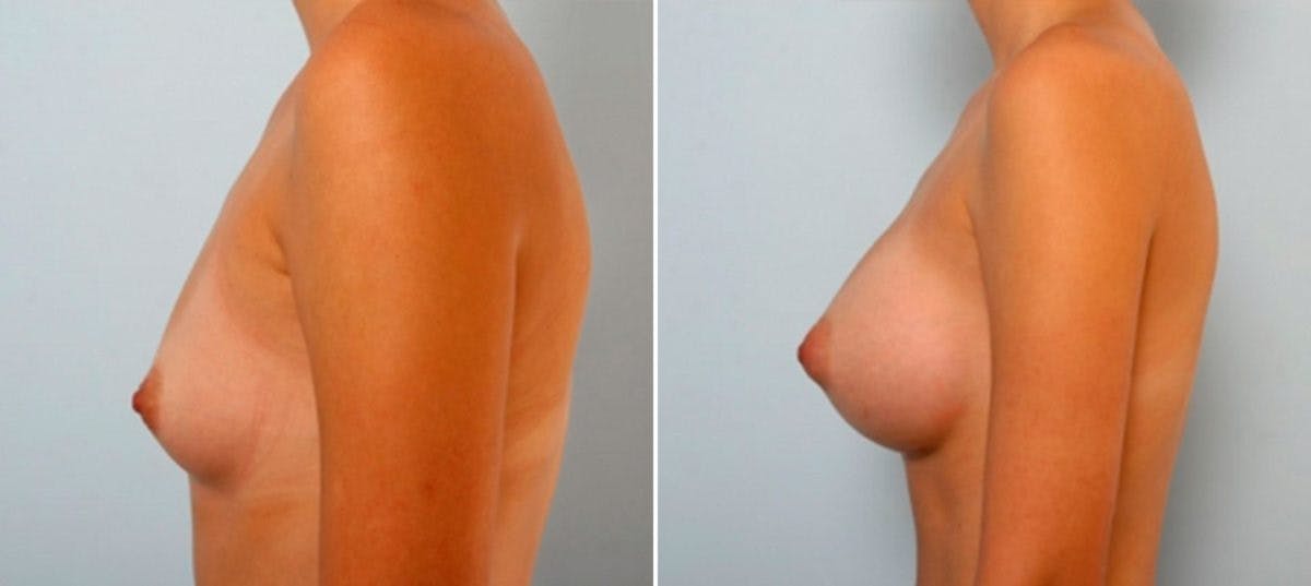 Breast Augmentation Before & After Gallery - Patient 54885977 - Image 5