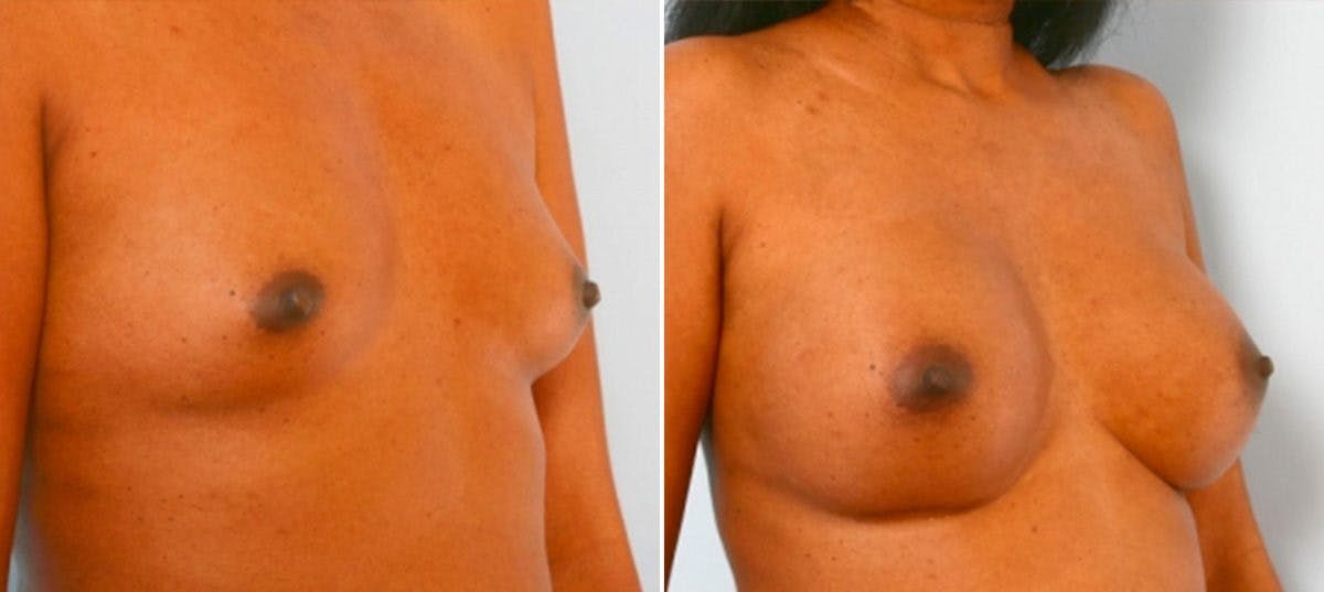Breast Augmentation Before & After Gallery - Patient 54885978 - Image 2