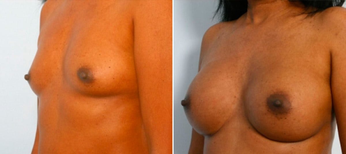 Breast Augmentation Before & After Gallery - Patient 54885978 - Image 4