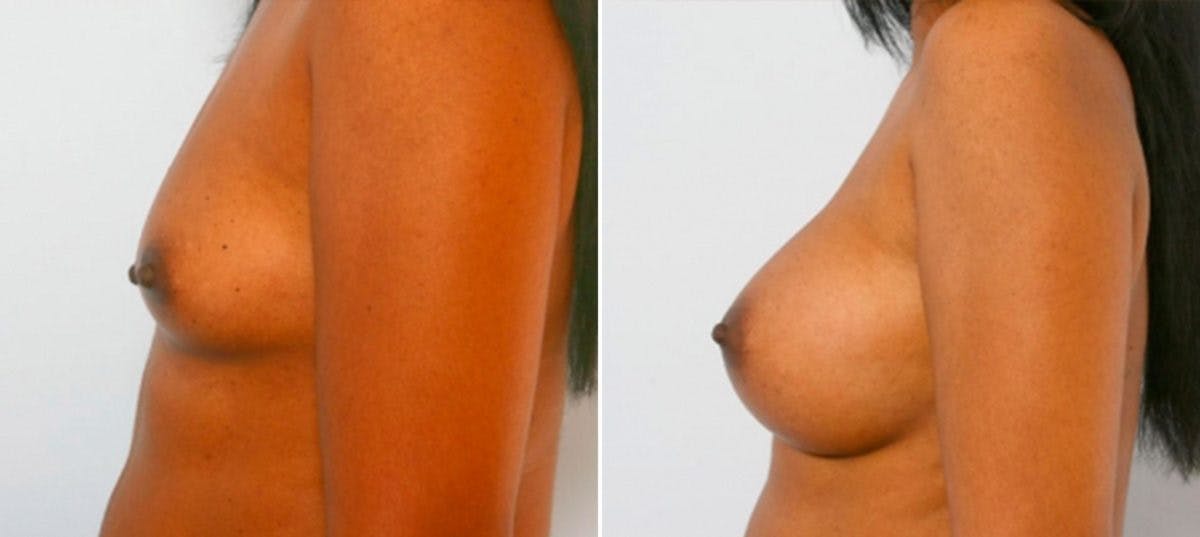 Breast Augmentation Before & After Gallery - Patient 54885978 - Image 5